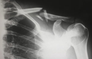 An x-ray of a broken shoulder